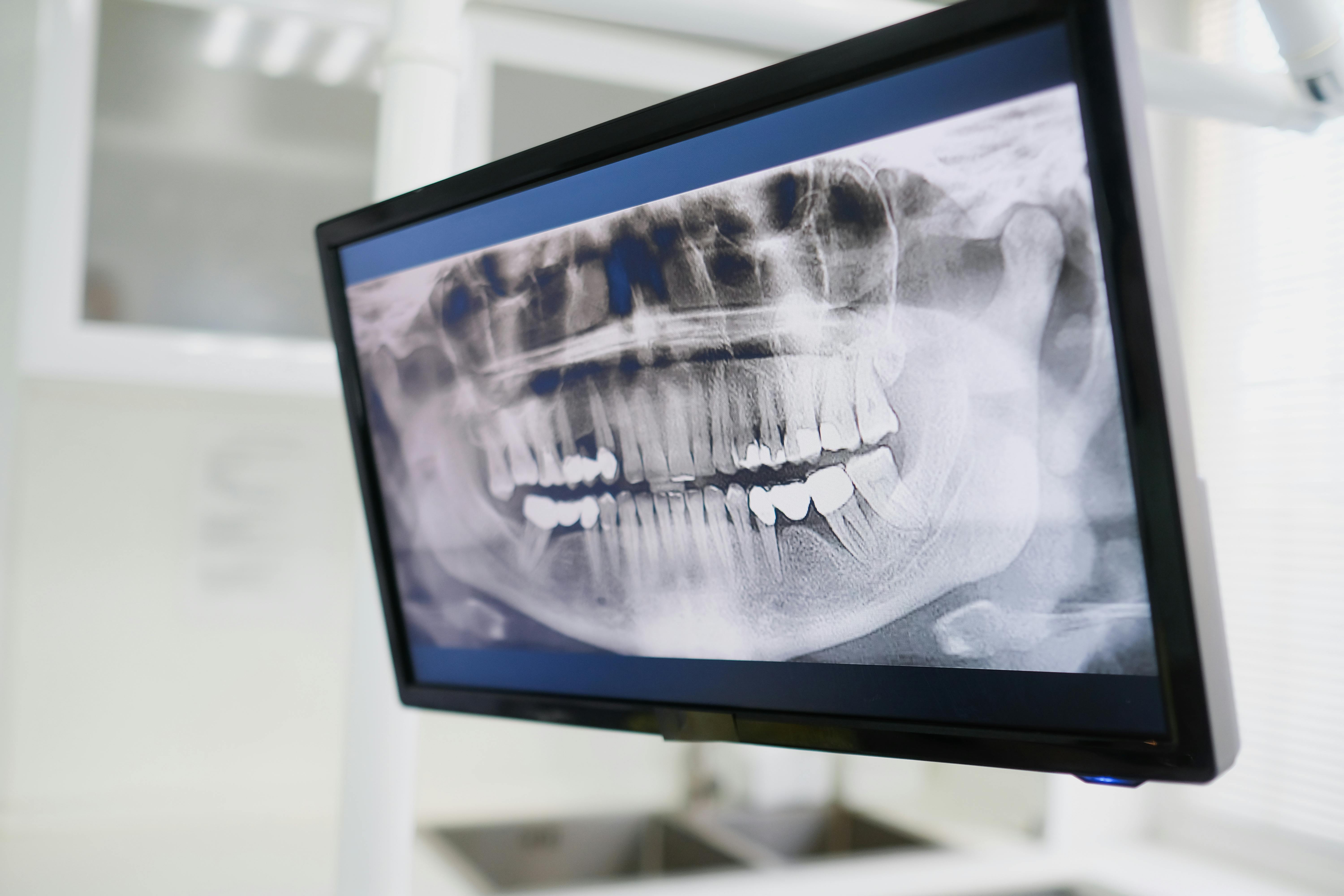 Direct conversion X-ray sensor application – dental intraoral and panoramic imaging