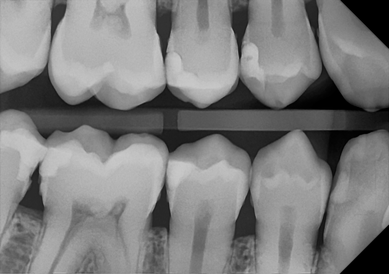DC-Air bitewing X-ray 1