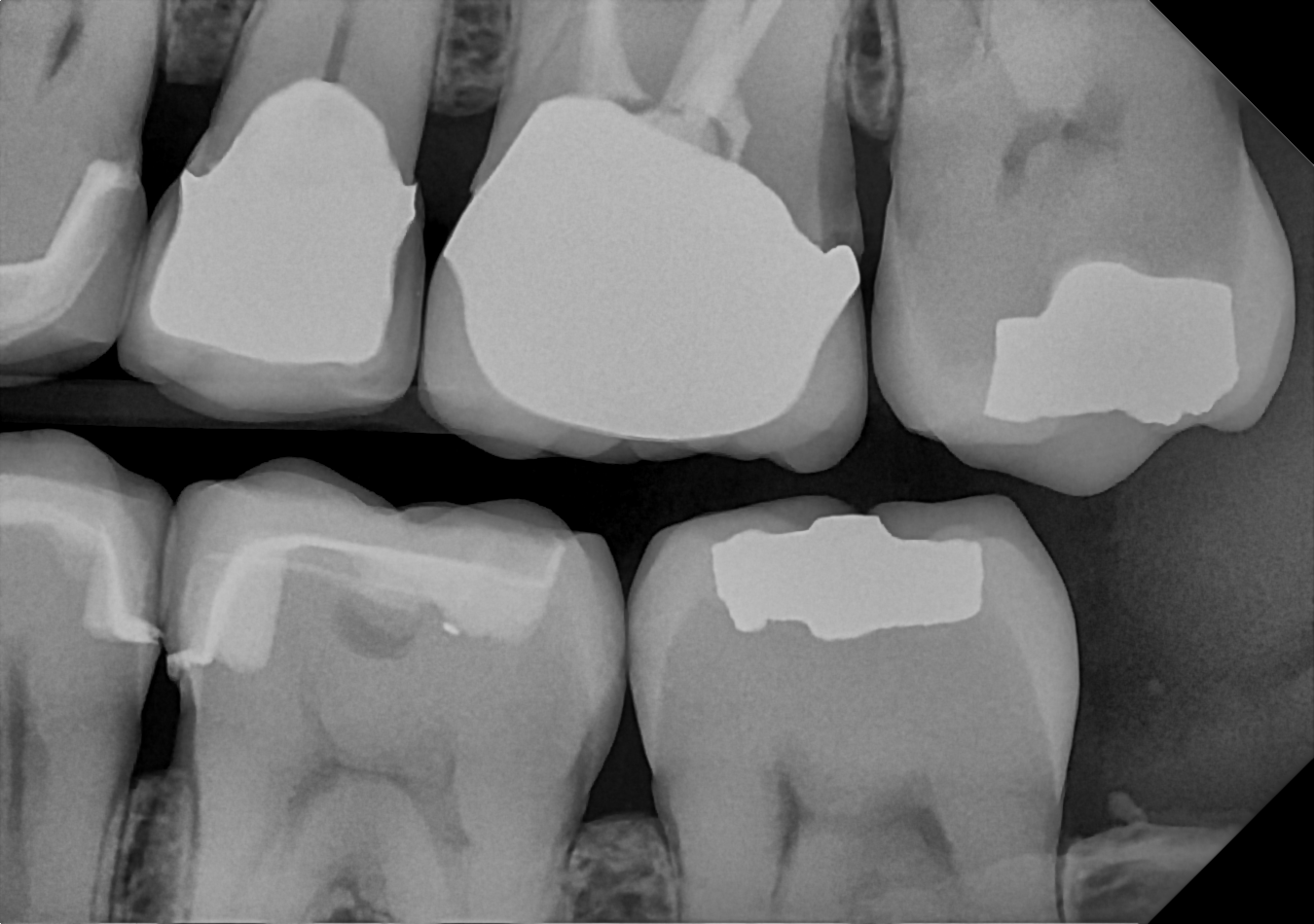 DC-Air bitewing X-ray 3
