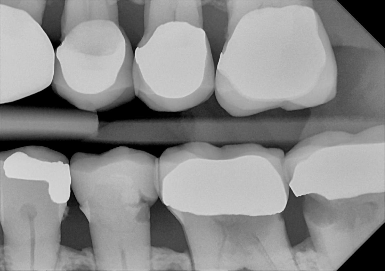 DC-Air bitewing X-ray 4
