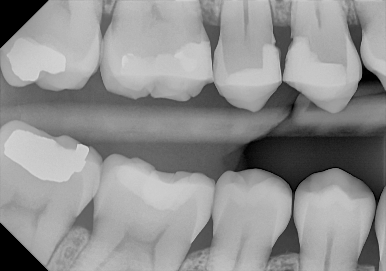 DC-Air bitewing X-ray 6