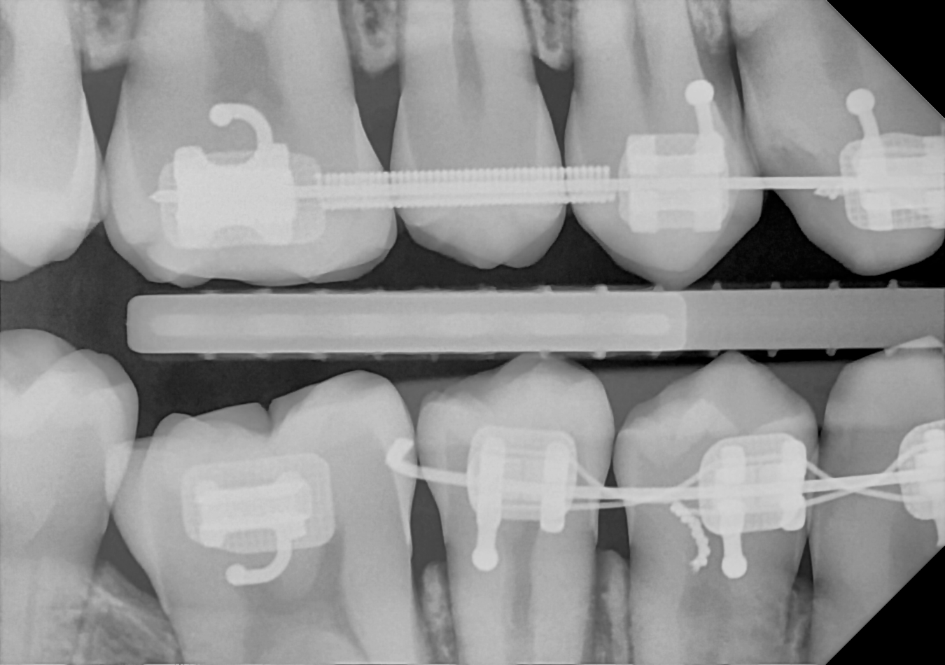 DC-Air bitewing X-ray 7