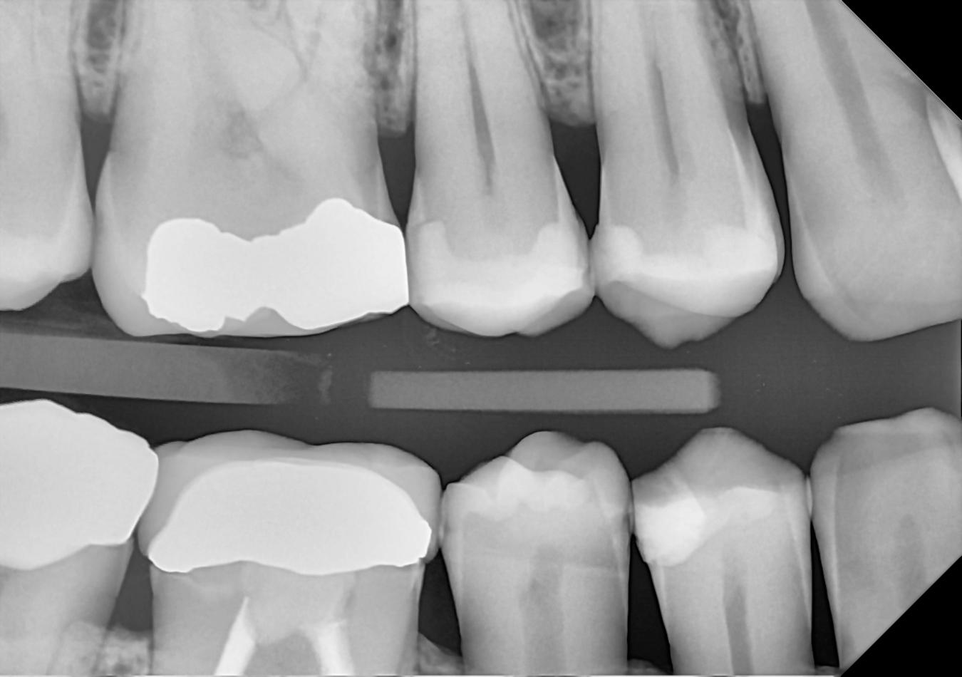 DC-Air bitewing X-ray 8